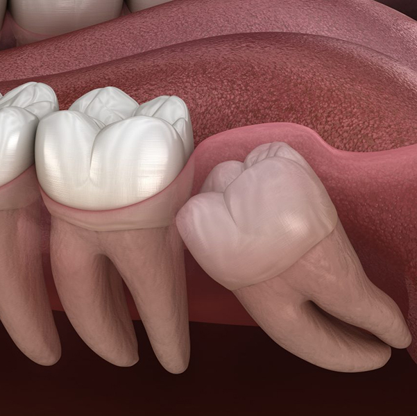 Chirurgia orale estrattiva Roma