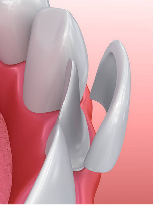 Faccette estetiche Roma